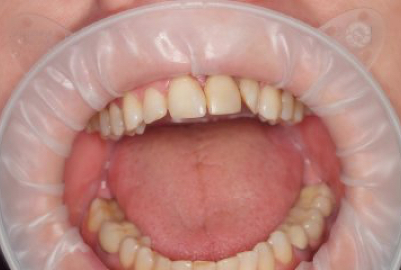 Безметалловые коронки Emax и виниры