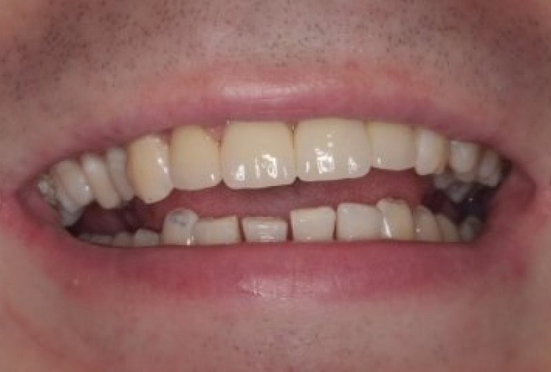 Виниры и безметалловые коронки Emex