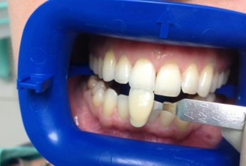 Отбеливание зубов