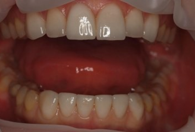 Устранение промежутков между нижними передними зубами