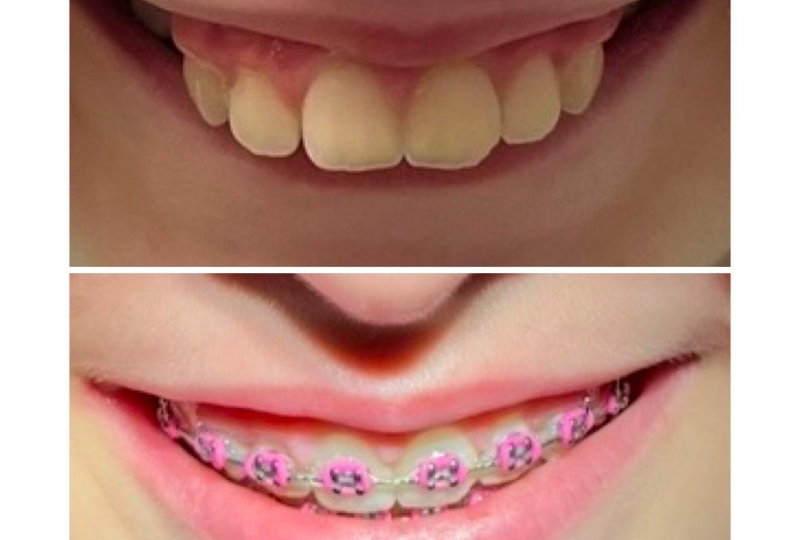 Ортодонтическое лечение