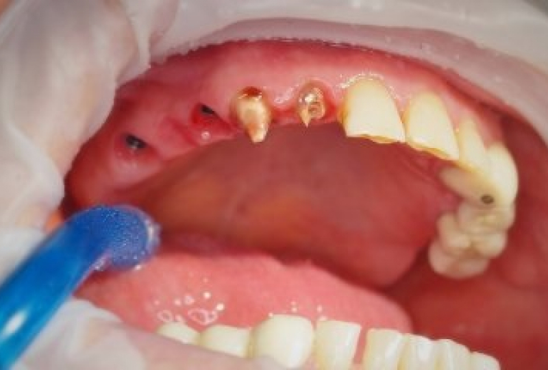 Дентальные импланты и ортопедическиеконструкции