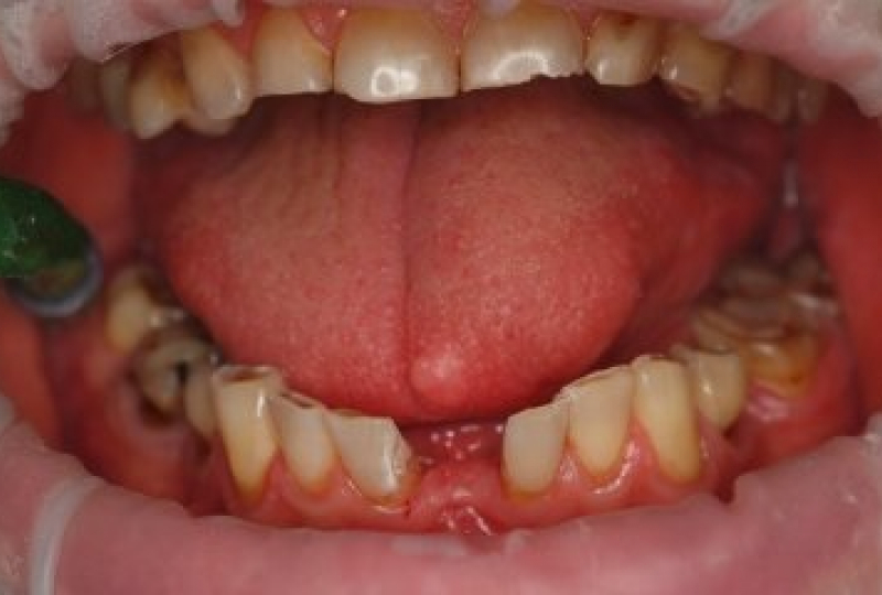 Установка искусственного зуба на стекловолокне