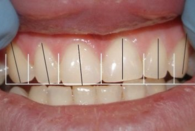 До и После: виниры на зубы в зоне улыбки