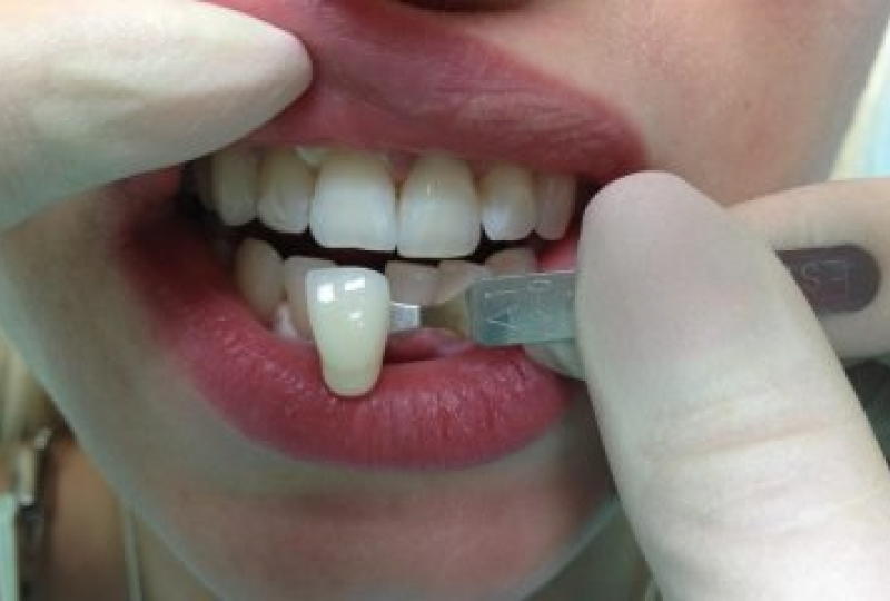 Отбеливание зубов