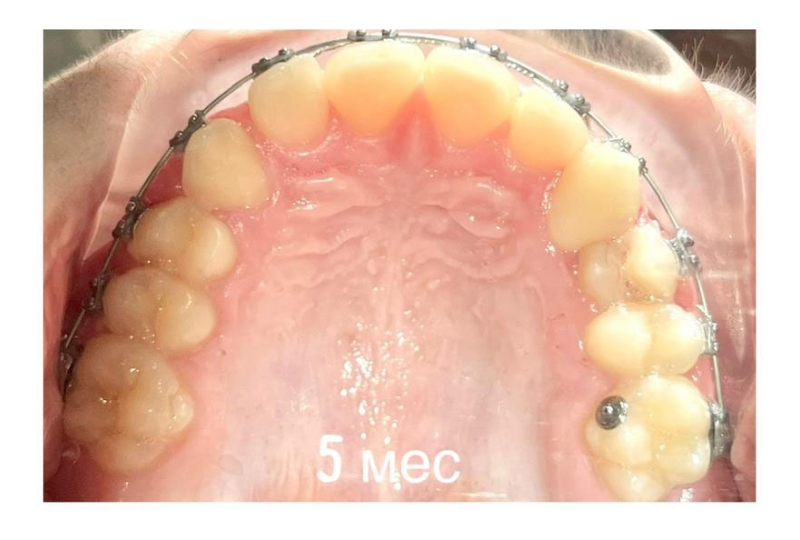 Ортодонтическое лечение