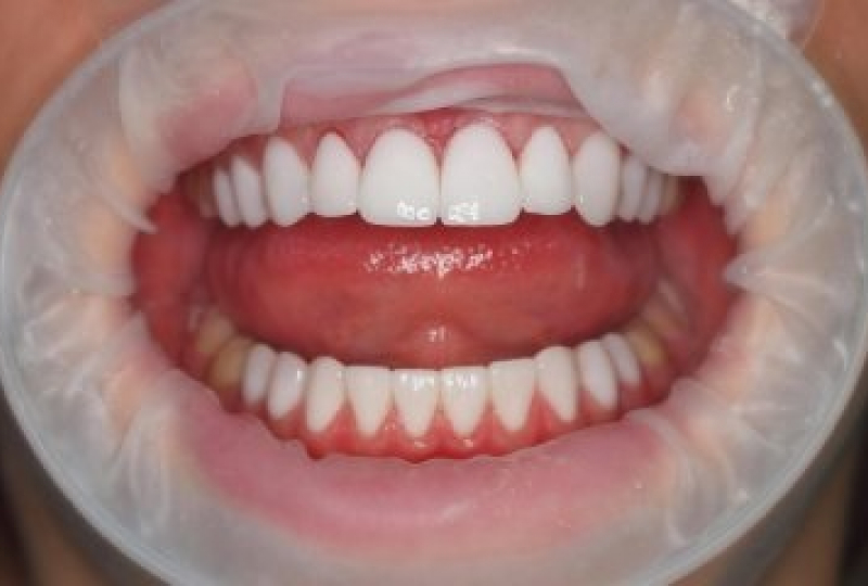 До и После: виниры на зубы в зоне улыбки