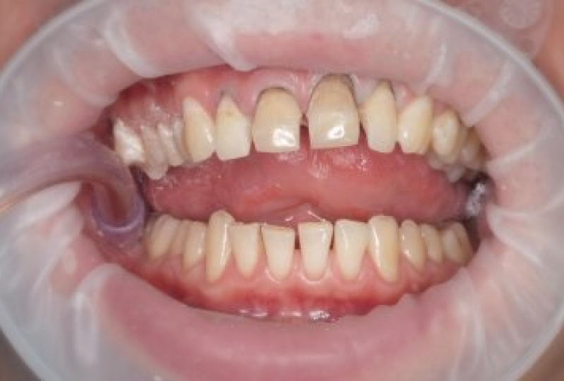 Виниры и безметалловые коронки Emex