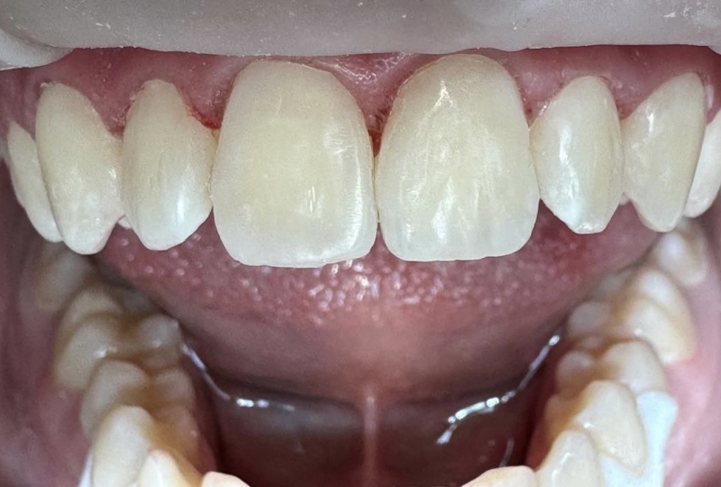 Реставрация передней группы зубов, 8 зубов. Диагноз множественный кариес, меловидные пятна
