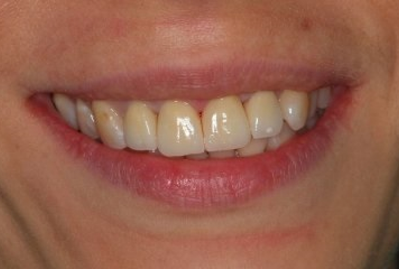 Установка коронок из безметалловой керамики Emax