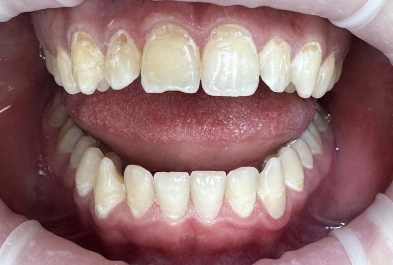 Реставрация передней группы зубов, 8 зубов. Диагноз множественный кариес, меловидные пятна